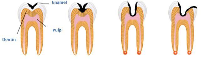Why Do I Keep Getting Cavities?
